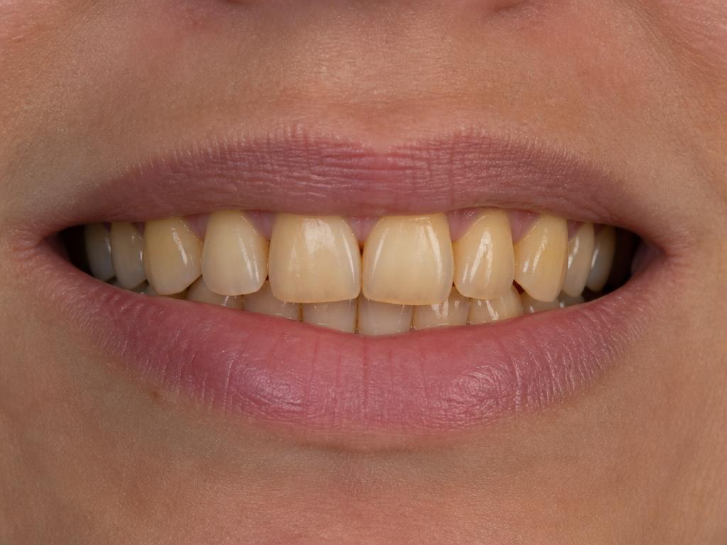 Before teeth whitening and smile correction